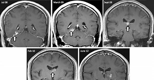 Worm That Lived in Man's Brain for Four Years Has Genome Mapped