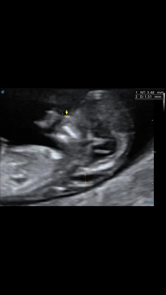 Pentingnya Nuchal Scan untuk Mengesan Petanda Syndrome
