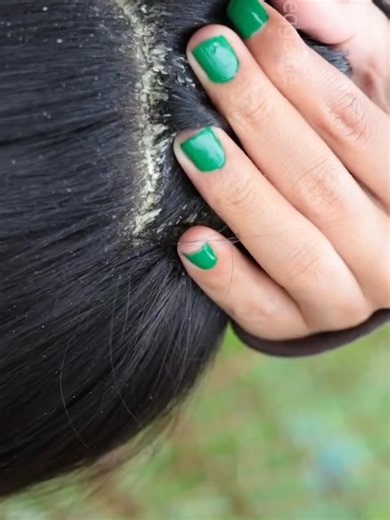 Dandruff layers breaking one by one. | Flake Lab