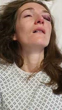 My bad fall during a Tonic Clonic seizure