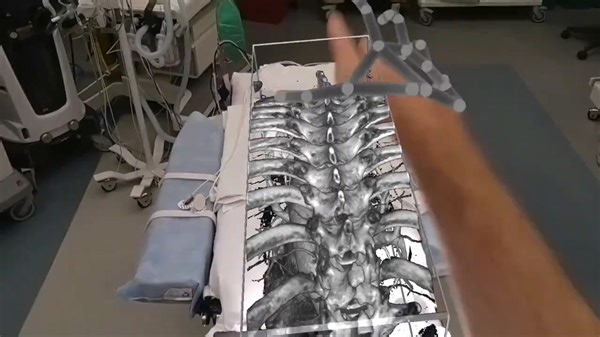 一款由AI驱动的AR手术平台-Medivis SurgicalAR，全息效果看着有点牛啊