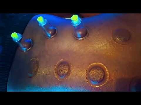 Hijama Cupping Training In London