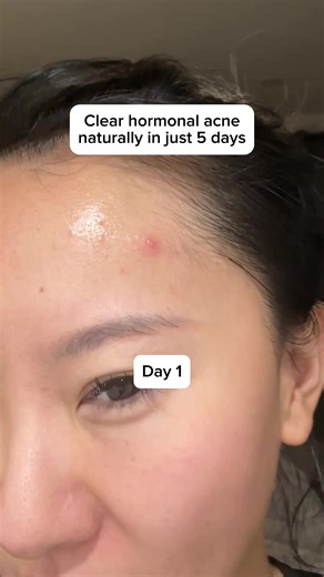 After years of struggling with hormonal acne…😱🤯 #hormonalacne #acneproneskin #clearskin #glowingskin #acnetreatment