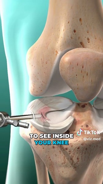 A partial meniscectomy is a surgical procedure to remove a portion of the meniscus, a crescent-shaped cartilage in the knee, to relieve pain and restore function, especially when a tear is not repairable or doesn't require a full repair. #cartilage #medicaleducation #medicalanimation #3danimation #3dmedicaleducation #3danimationsurgery