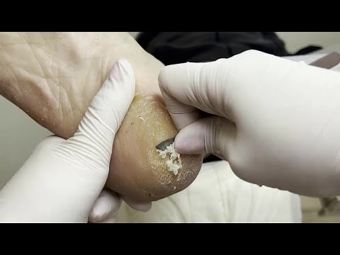 Removing Extremely Massive Heel Callus - Bones Under Pressure Full Treatment 🦶 Foot Callus Podiatry