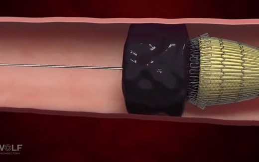 DeVoro Medical的Wolf Thrombectomy机械取栓系统
