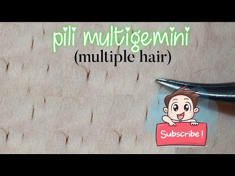 PILI MULTIGEMINI - extraction of multiple hair in one follicle
