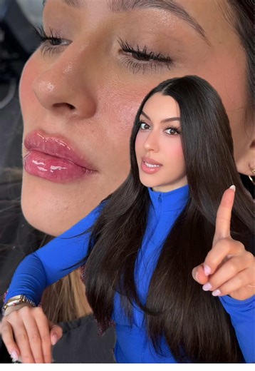 Expert Lip Injection Techniques for Perfectly Shaped Lips