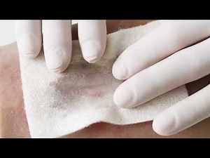 Coloplast Biatain Alginate demo