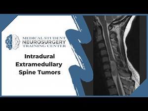 Intradural Extramedullary Spine Tumors