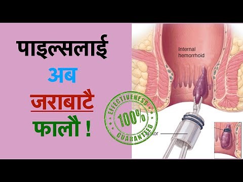 payals ko upachar rubber band ligation bata/piles home treatment/pails problem solution at home