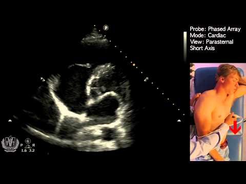Parasternal Short Axis View - Transthoracic Echocardiography (Ultrasound)