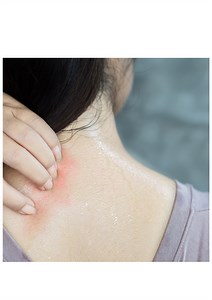 Simple Home Remedies for Jock Itch or Sweat Rash