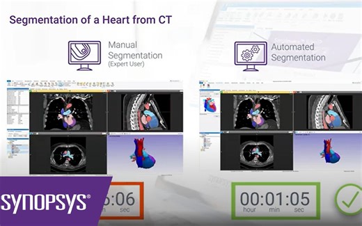 【Simpleware】心脏自动化分割 AS Cardio 模块