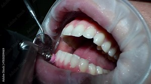 Professional dentist conducts a thorough check-up of woman teeth, inspecting for cavities, gum health, and overall oral hygiene. 4k cinematic raw slow motion video
