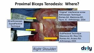 Why Open Subpectoral Tenodesis Is the Best Choice and How I Do It