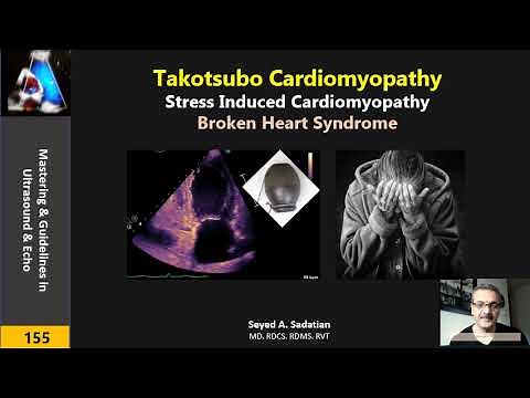 Takotsubo Cardiomyopathy or Broken Heart Syndrome