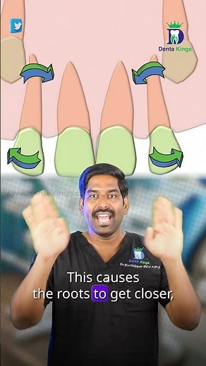 பத்து வயது தெத்து பல்லை சரி செய்வது எப்படி? - Ugly duckling stage | Dr.Karthikeyan | Denta Kings