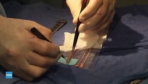 Brachial Plexus Repair Using Sural Nerve Graft With Fibrin Glue
