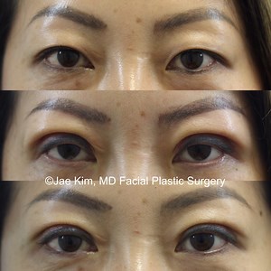 Asian Plastic Surgery Fairfax, Virginia | Asian Rhinoplasty & Eyelid Surgery
