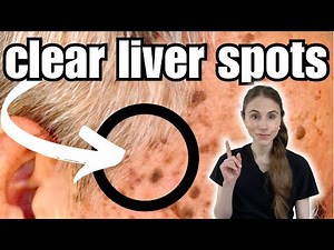 Get Rid Of Liver Spots FAST | Seborrheic Keratosis
