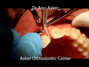 Frenectomy labial-Midline diastema orthodontic closure by Dr.Amr Asker at Asker Orthodontic Center