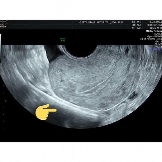 sliding sign, endometriosis, pelvic adhesions, Dynamic ultrasound.