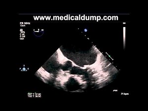 Left Atrial Appendage Thrombus - TransEsophageal Echocardiogram (TEE)