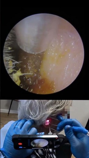 IMPACTED DARK EAR WAX PLUG REMOVAL - EP721 TEASER