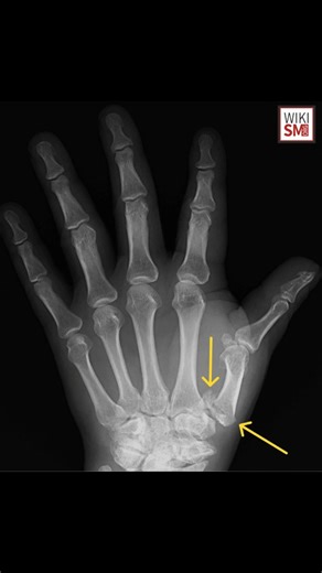 102K views · 1.1K reactions | A Rolando fracture is a comminuted...