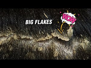 Big Flakes Scratching Satisfying - Dandruff Removal #1267