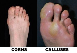 Seattle Area Corns and Calluses Care