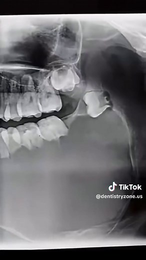 Ameloblastoma: Clinical, Radiographic, and Histologic Features