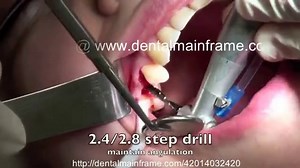 Internal Sinus lift - Osteotome technique