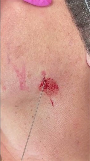 Doctor's Cannula Secrets: Pressure & Retrograde Injection! #shorts