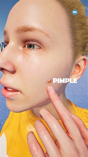 What causes Pimple? Acne firmation explained