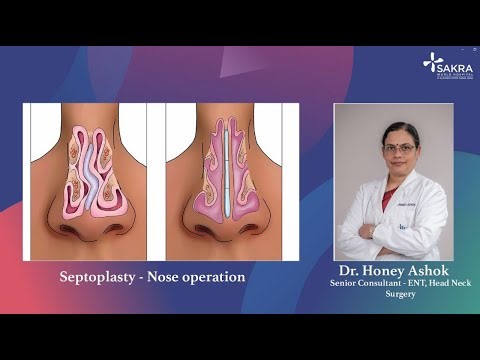Septoplasty- Nose Operation | Sakra World Hospital