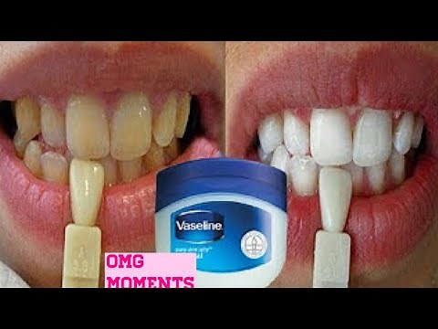 Turn dirty yellow teeth to White in just 3 minutes