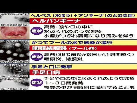 子供の夏の感染症が急増中…専門家に聞いた「3大夏かぜ」の症状と対策は