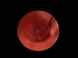 Right Endoscopic PE Tube Placement - EndoEarScape
