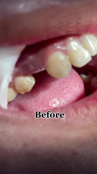 FRC Bridge: Gigi Palsu Permanen dengan Bahan Tambal Gigi