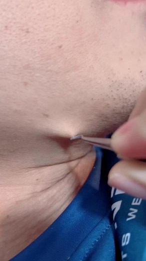 ดึงขนคุด ด้วยแหนบหนีบสิวเสี้ยน 🤩 เริ่ดมาก #พี่นุกรีวิว #tiktokครีเอเตอร์ #รีวิวของดีบอกต่อ #ของดีบอกต่อ #ของใช้ในบ้าน789