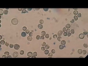 Blood smear shows Reticulocyte staining by New methylene blue (100X)
