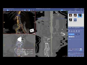 Endovascular Aortic Repair Preoperative Sizing with Audible Bleeding