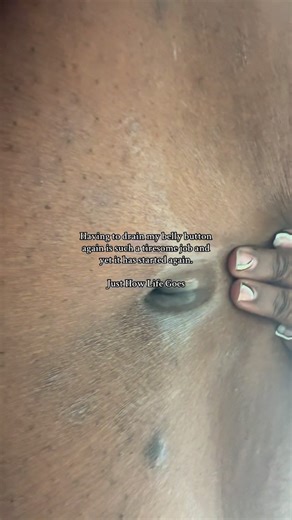 Destineé Spruell on Instagram: "Draining a belly button every day is a different type of exhaustion. Not the kind you can sleep off, not the kind people understand when they hear it… but the kind that follows you everywhere — mentally and physically. Having to constantly check your clothes… Making sure nothing leaked through… Cleaning the area over and over again… Managing the odor, the moisture, the pain, the irritation… It’s a full-time job nobody signed up for. People don’t realize how draini