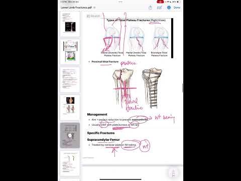 Lower Limb Fractures Pt 2