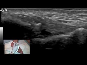 Ultrasound tutorial - Imaging of the Anterior Talofibular Ligament