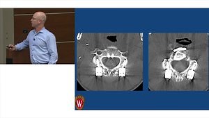 Lateral Mass Screw Fixation