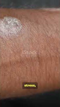 Hand Psoriasis Explained: Causes, Symptoms, Treatment & Daily Care Tips