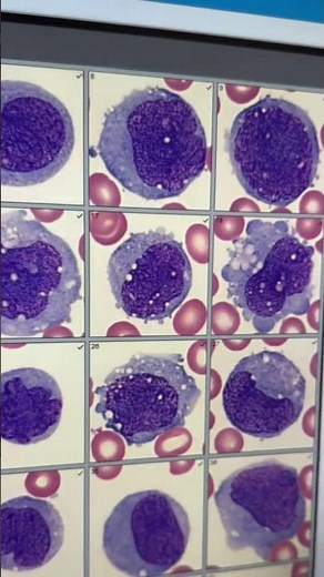 Blood CANCER Under The MICROSCOPE 🔬🩸 #healthcare #science #laboratory
